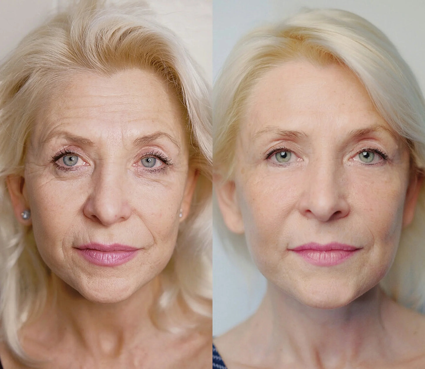 Natravor® Instant Wrinkle-Reducing Natural Cream