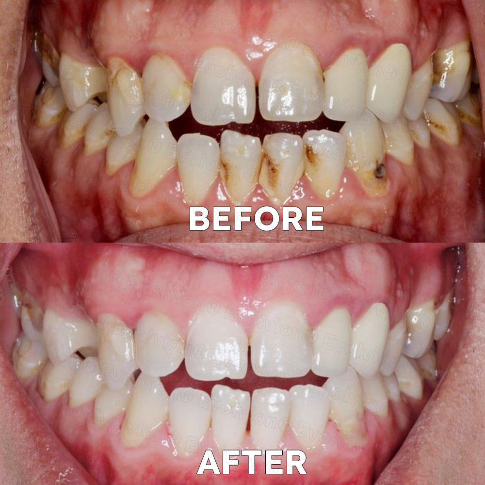 ✅Official Store |🗽Frinoxio® Fluoride-Free Nano Hydroxyapatite Tooth Powder 👨‍⚕️ (Treats periodontitis and oral ulcers, cleans tartar, and repairs receding gums)
