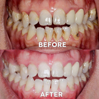 ✅Official Store |🗽Frinoxio® Fluoride-Free Nano Hydroxyapatite Tooth Powder 👨‍⚕️ (Treats periodontitis and oral ulcers, cleans tartar, and repairs receding gums)