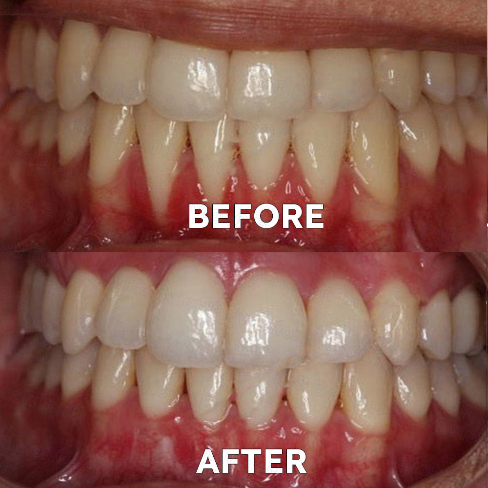 ✅Official Store |🗽Frinoxio® Fluoride-Free Nano Hydroxyapatite Tooth Powder 👨‍⚕️ (Treats periodontitis and oral ulcers, cleans tartar, and repairs receding gums)