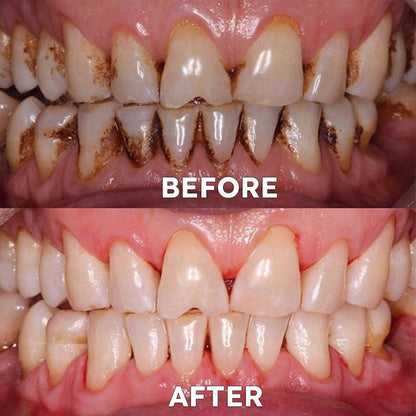 ✅Official Store |🗽Frinoxio® Fluoride-Free Nano Hydroxyapatite Tooth Powder 👨‍⚕️ (Treats periodontitis and oral ulcers, cleans tartar, and repairs receding gums)