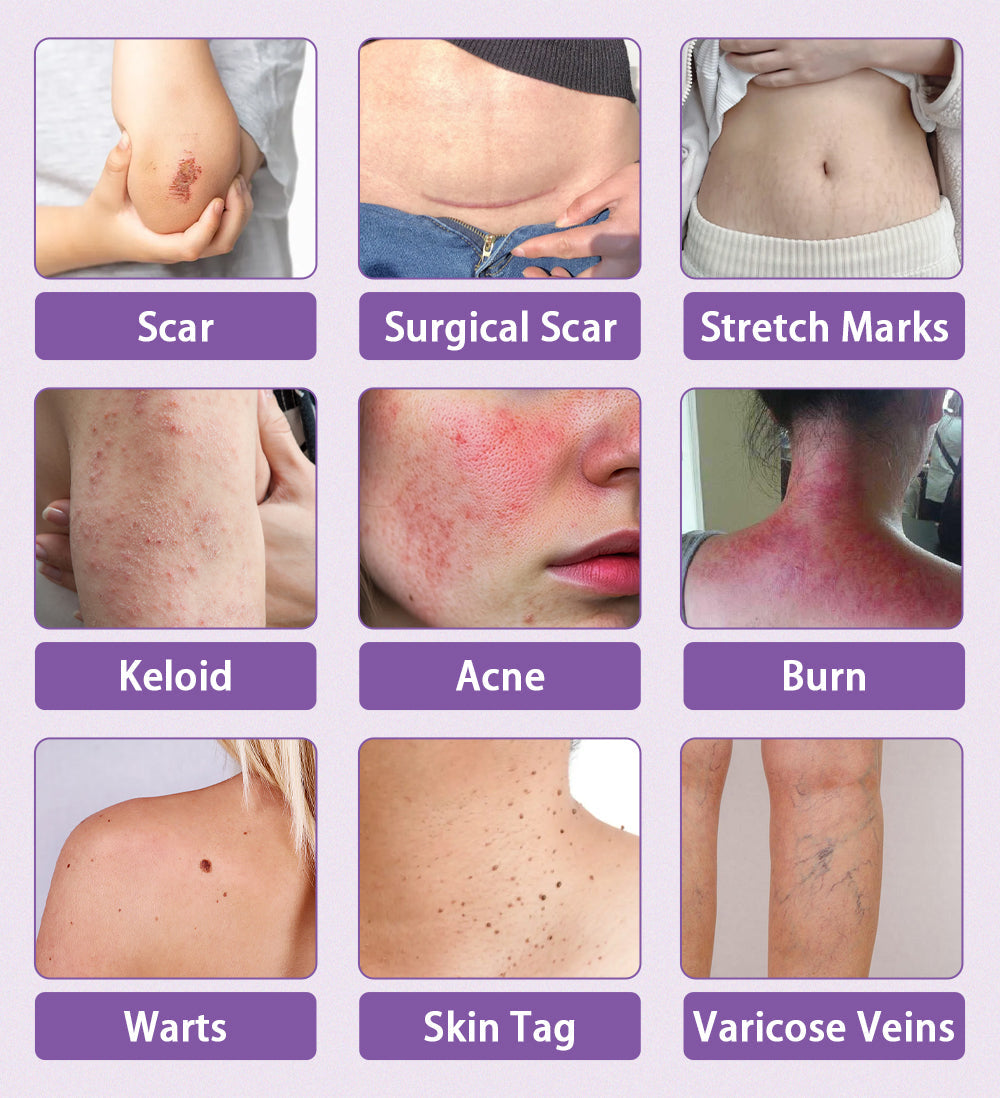 Natravor® Microneedle stretch mark patch